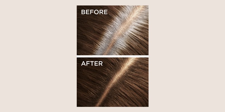 Inarticle Premature Gray Hair 20s1